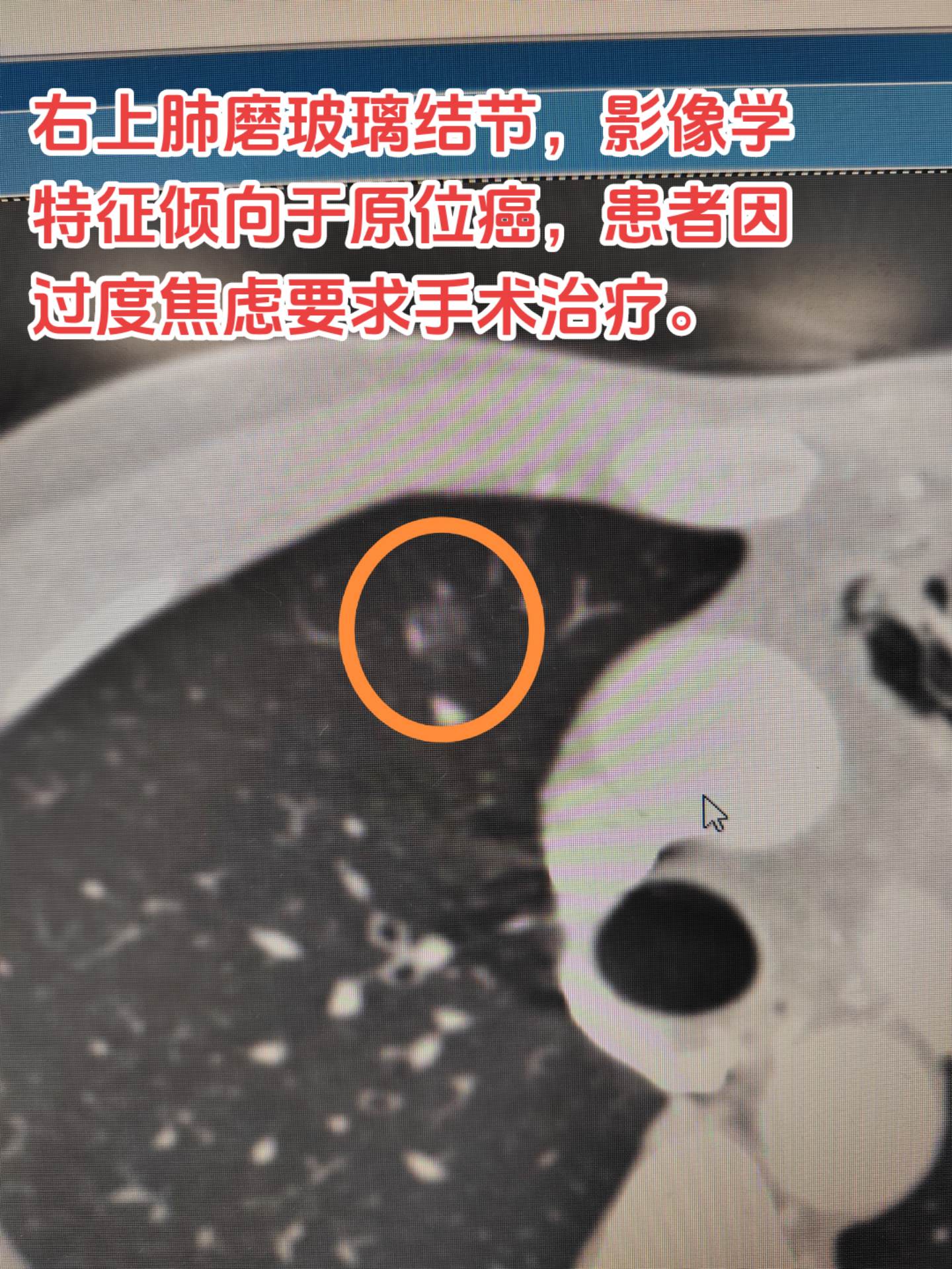 磨玻璃结节会是微浸润性癌吗？其实对于经观察不变的小磨玻璃结节一般多见的是不典型腺瘤样增生或原位癌。但是对于较大的纯磨玻璃结节也不除外是微浸润性癌，即使CT值小于-500。该例患者就是一个很好的例子。
