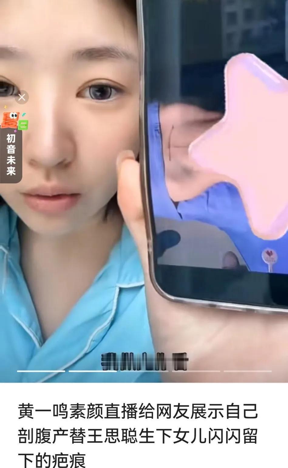 黄一鸣在直播间向网友展示，自己剖腹产的疤，并说自己太忙了，没有时间去修复。
黄一