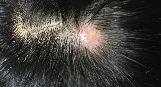 你是否曾因头皮上的疙瘩和脓包感到困扰，甚至自我安慰“这只是排毒”？

事实上，头
