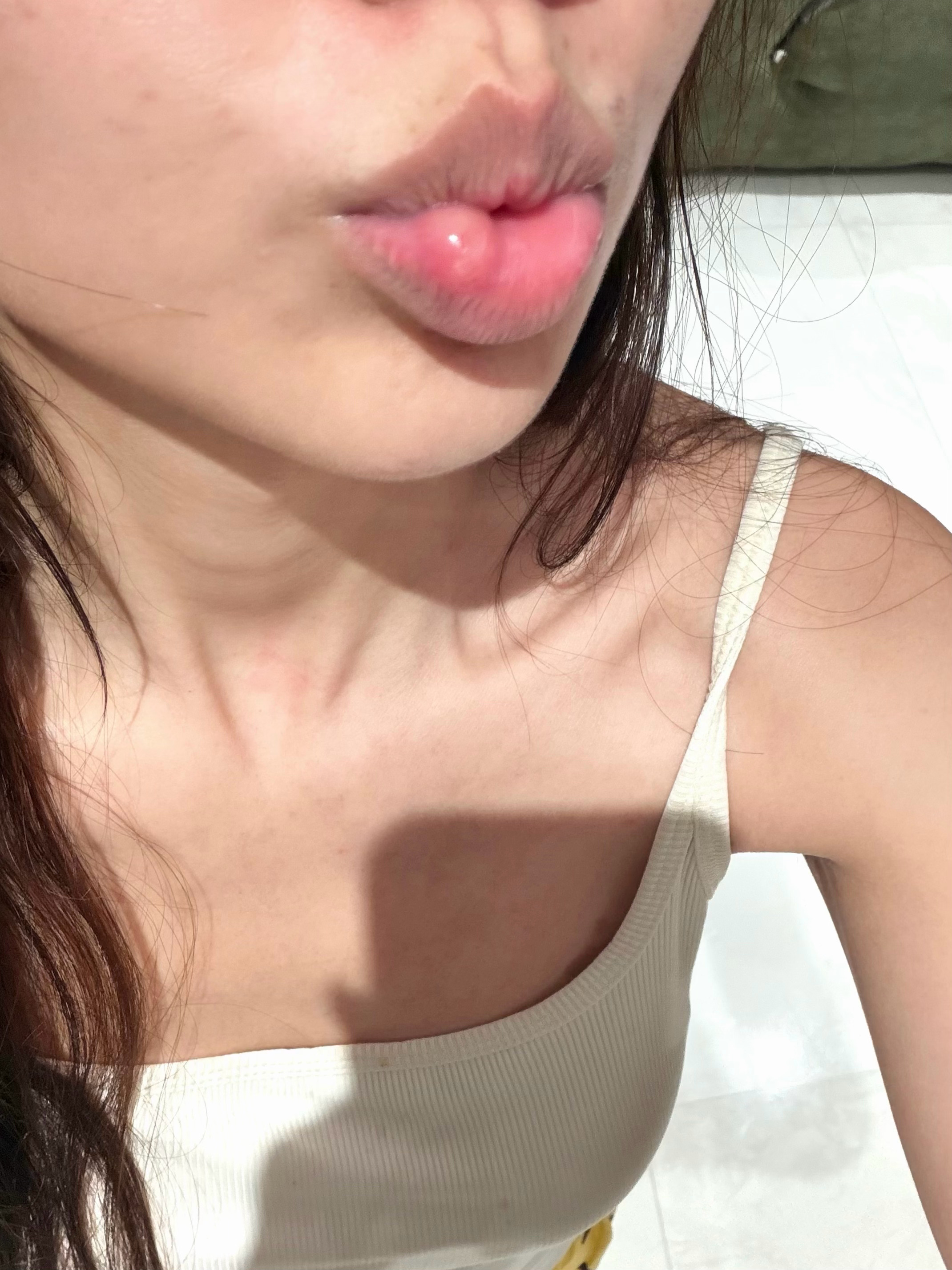 所有人…禁止撕嘴皮。。。我刚刚手贱撕了一下瞬间肿了一个这么大的泡！！！谁懂一下