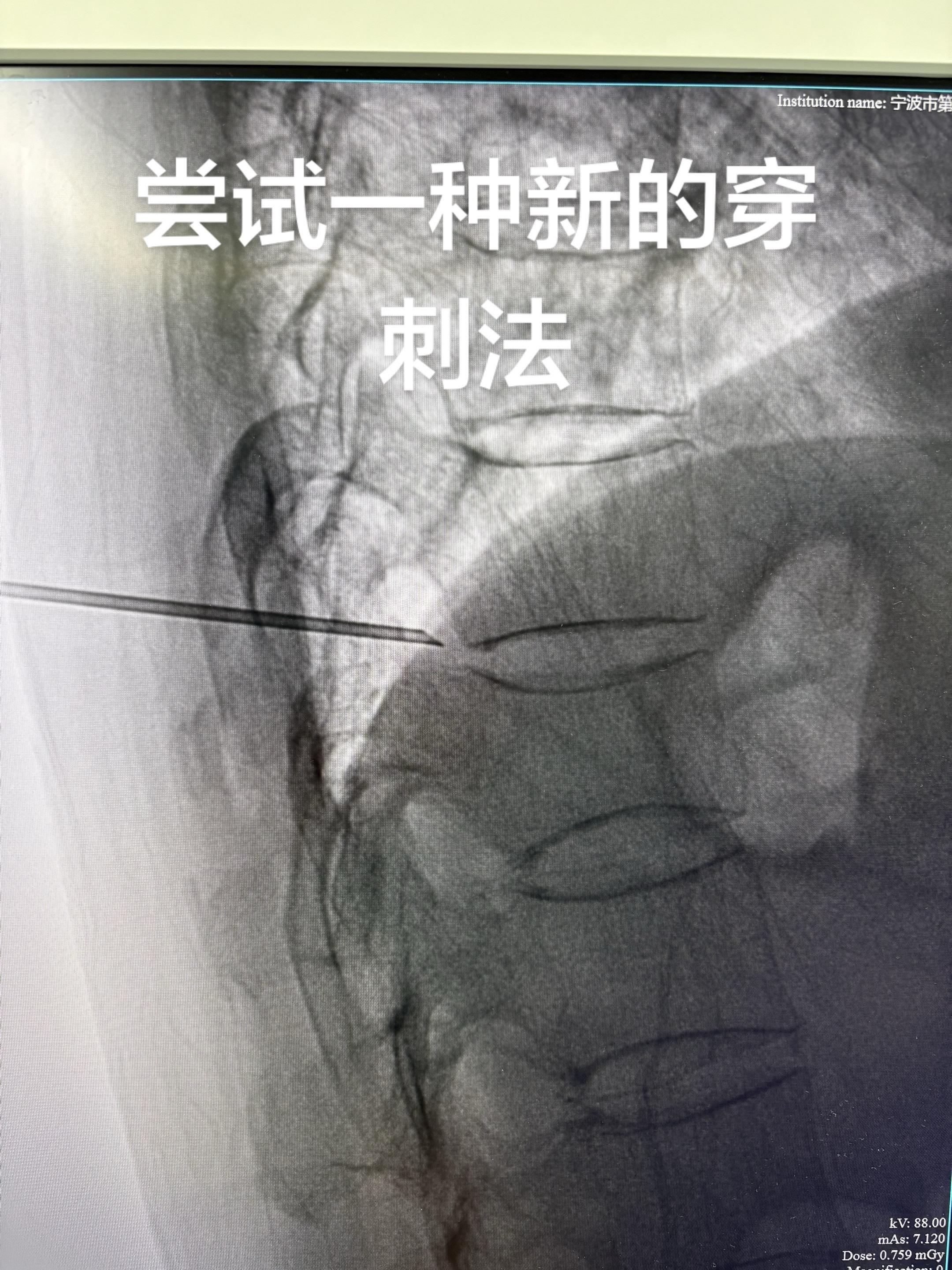 尝试一种新的穿刺方法。穿刺路径有点类似经典的孔镜BEIS技术。从椎体后...