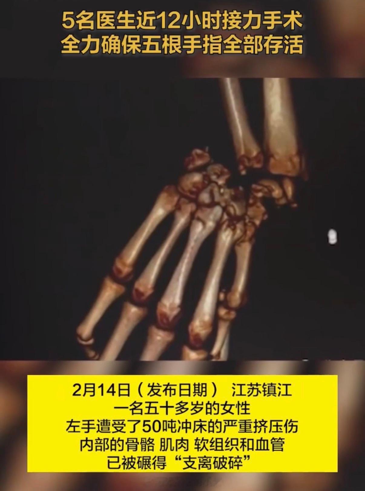 女子左手被50吨冲床碾成泥 听这新闻真揪心，50吨冲床一压，手都成“泥”了，换以