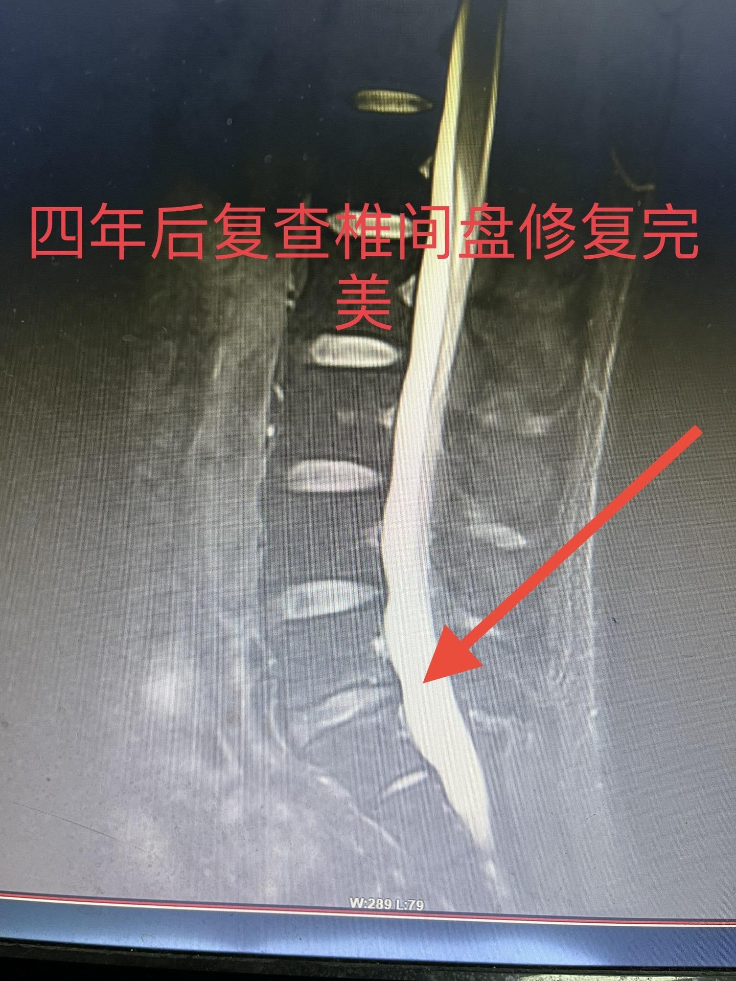 今天四年前的内镜病人来复查。椎间盘恢复非常完美。微创优势很明显。