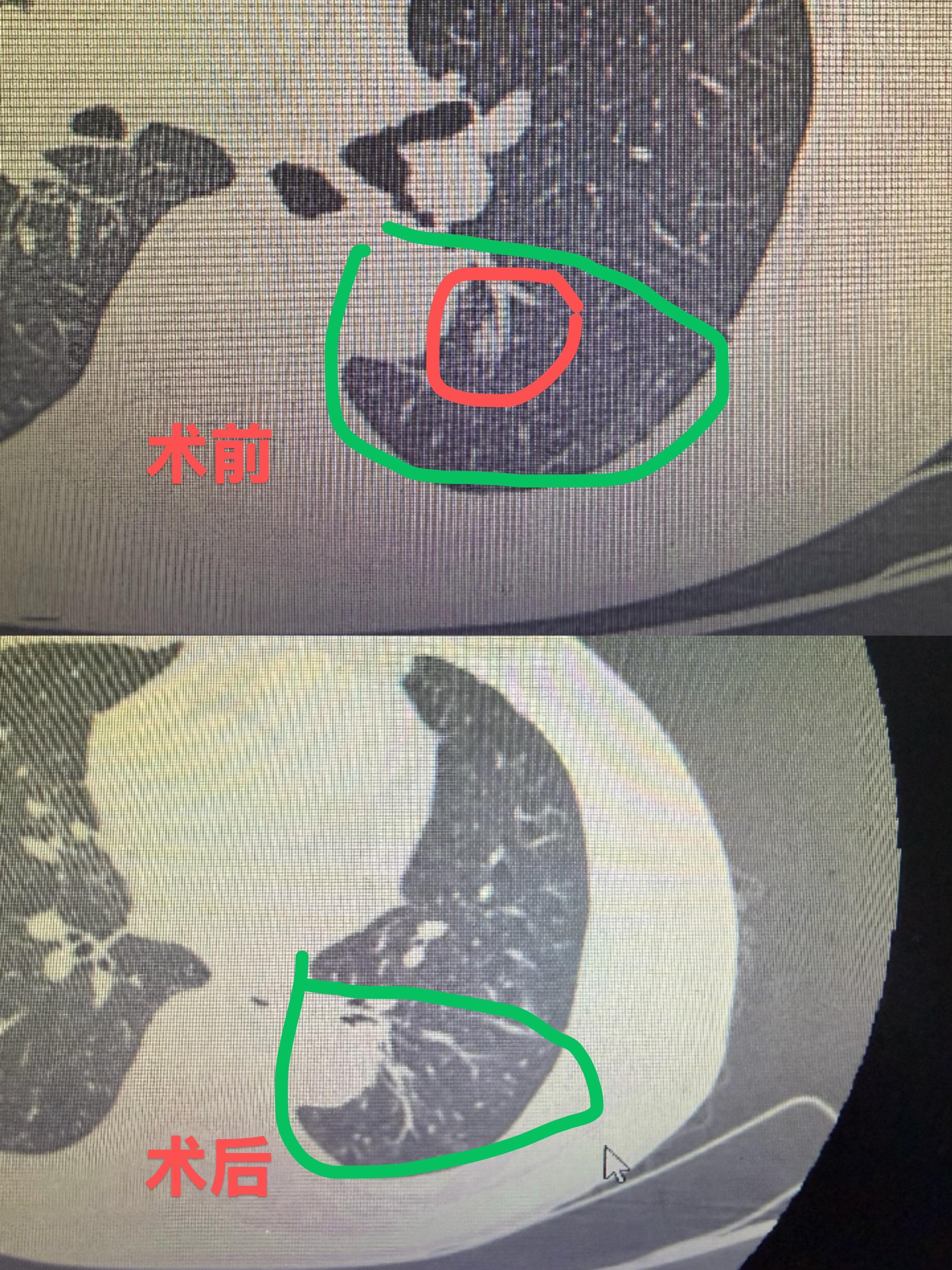 这个手术做得怎么样？74岁老爷子，手术后恢复得非常好，咳嗽，胸痛统统都...