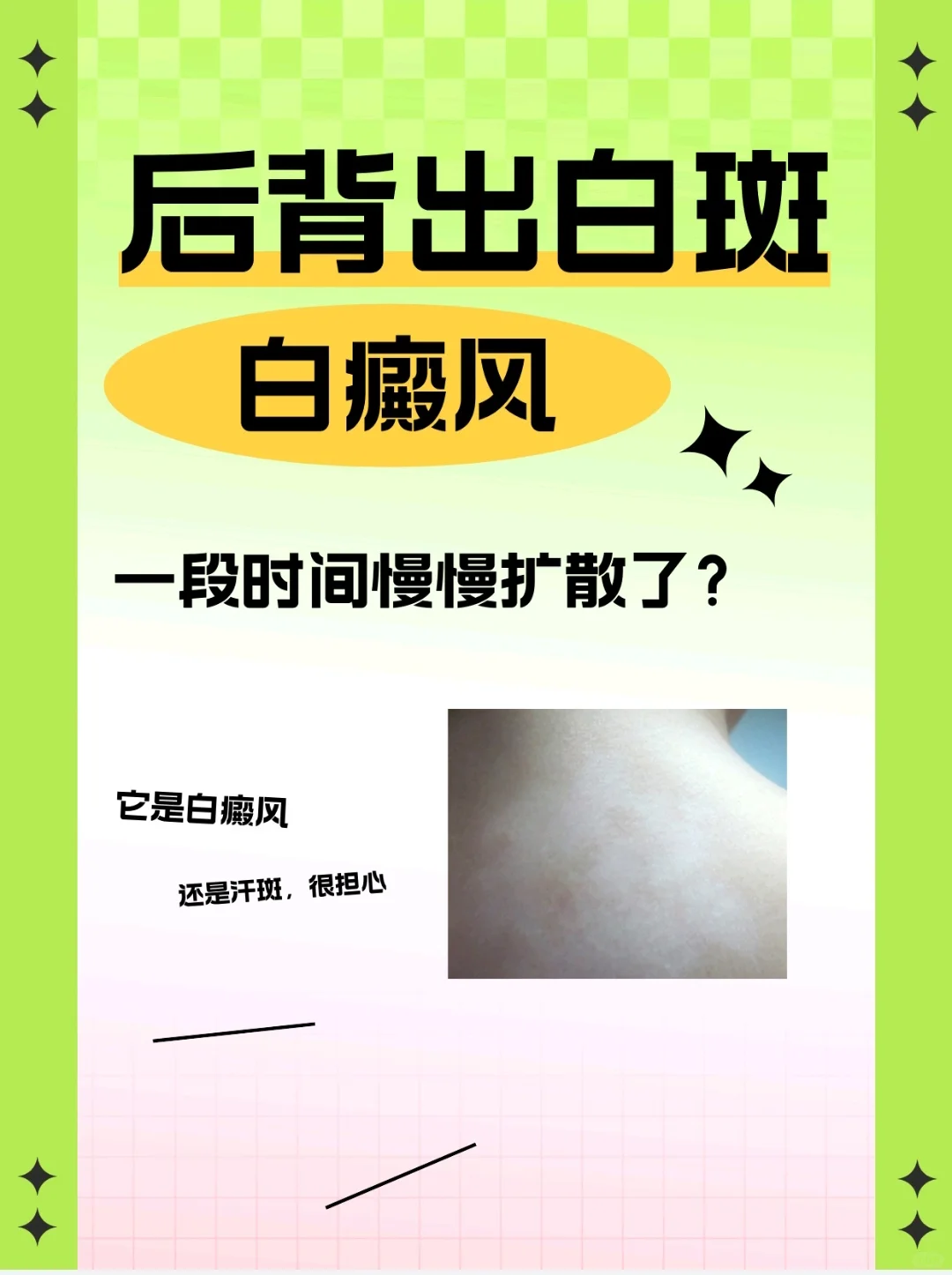 发现背上白斑白癜风还是汗斑，‼️慢慢扩散