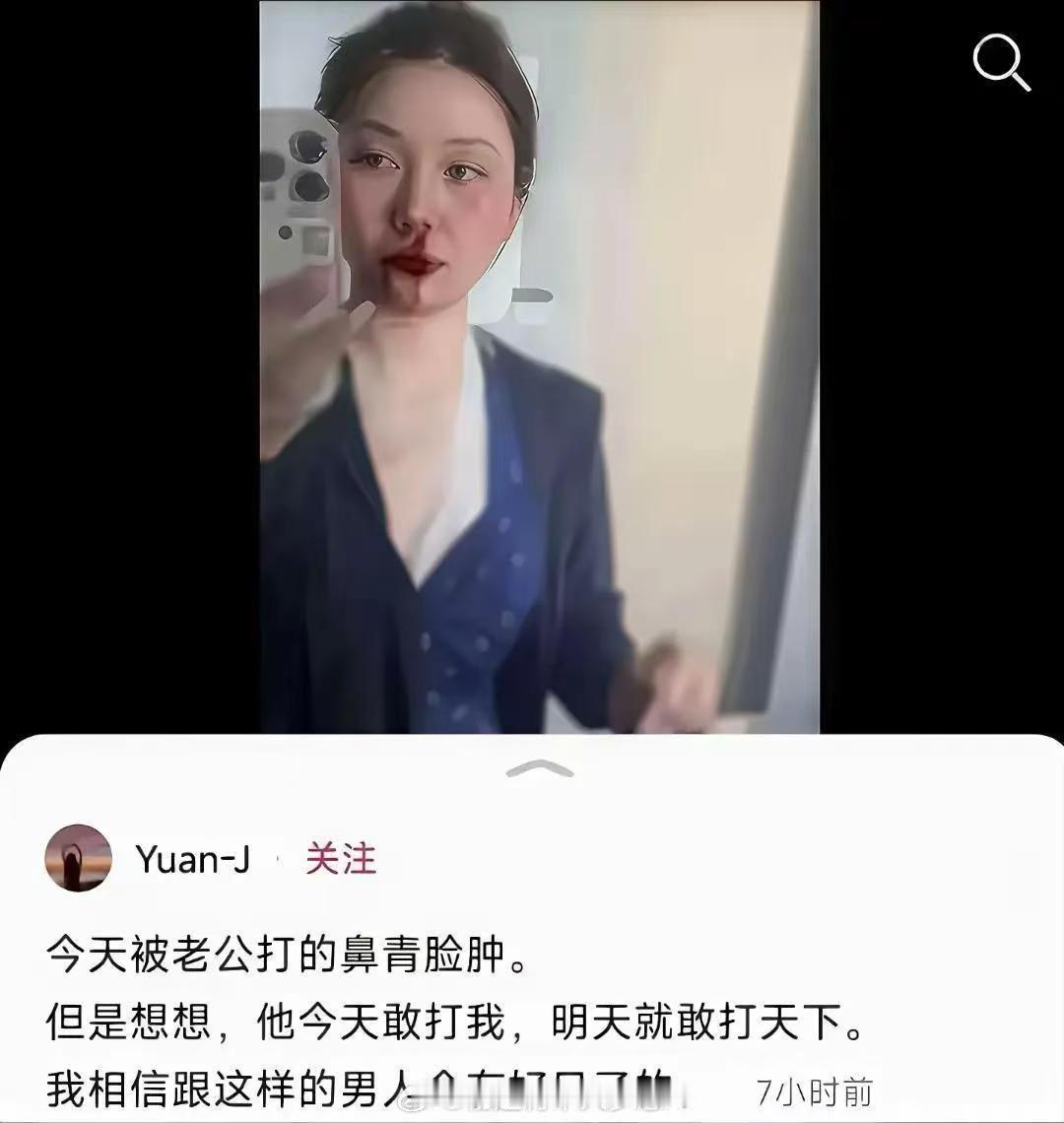 今天被老公打的鼻青脸肿。但是想想，他今天敢打我，明天就敢打天下。我相信跟这样的男