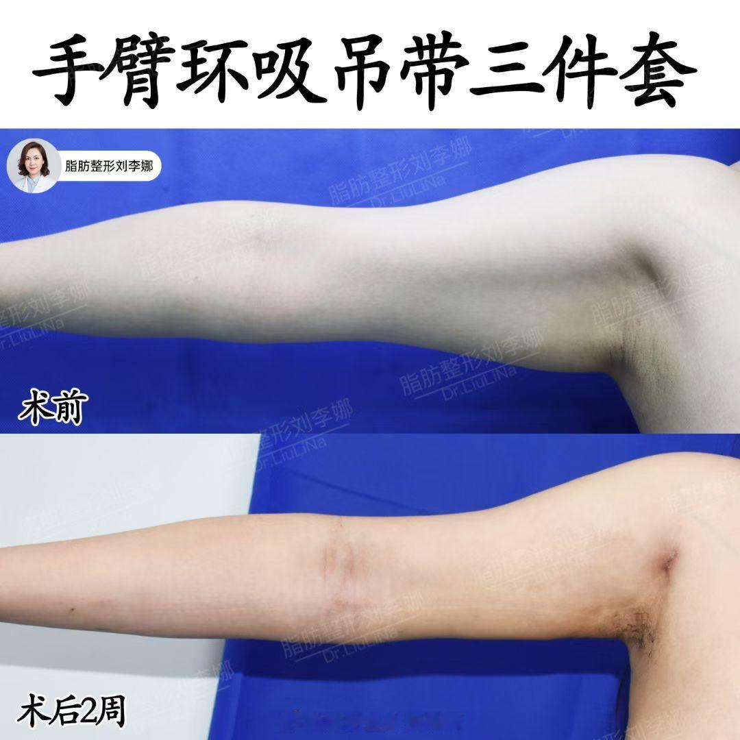脂肪整形刘李娜手臂吸脂手臂抽脂 手臂环吸吊带三件套+黄金微雕术后2周，肉眼可见拜