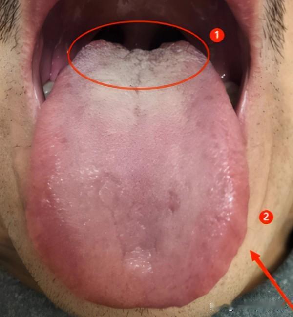 年少不知精贵，如今微软不起，40多岁的年纪最多一分钟！

患者主诉：今年41岁，