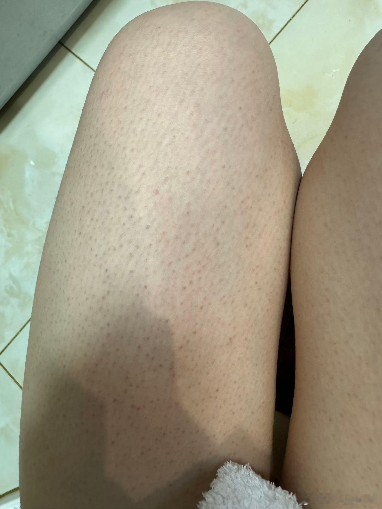 图1是我之前的腿……………..冬天光腿出门冻一腿鸡皮 ​​​