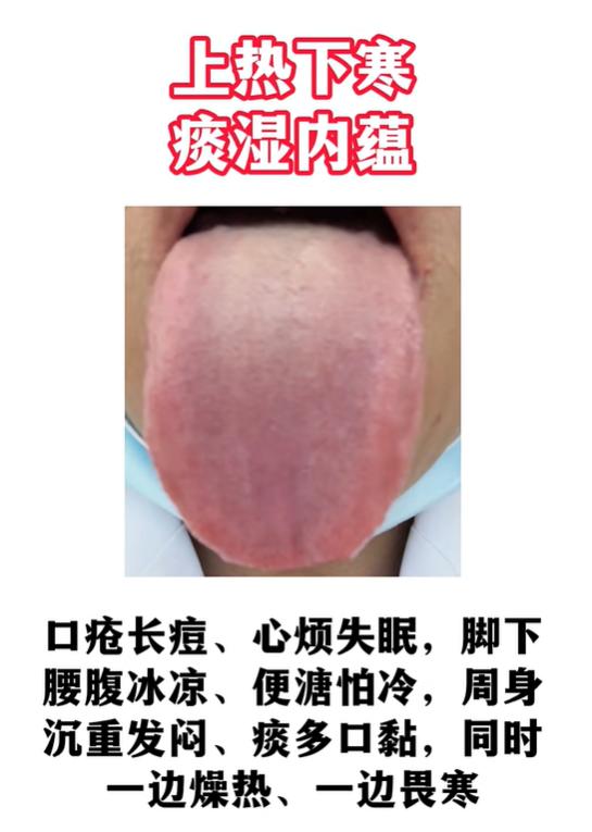齿痕厚苔暗藏体虚问题，三种典型舌象，对照症状找准体质根源