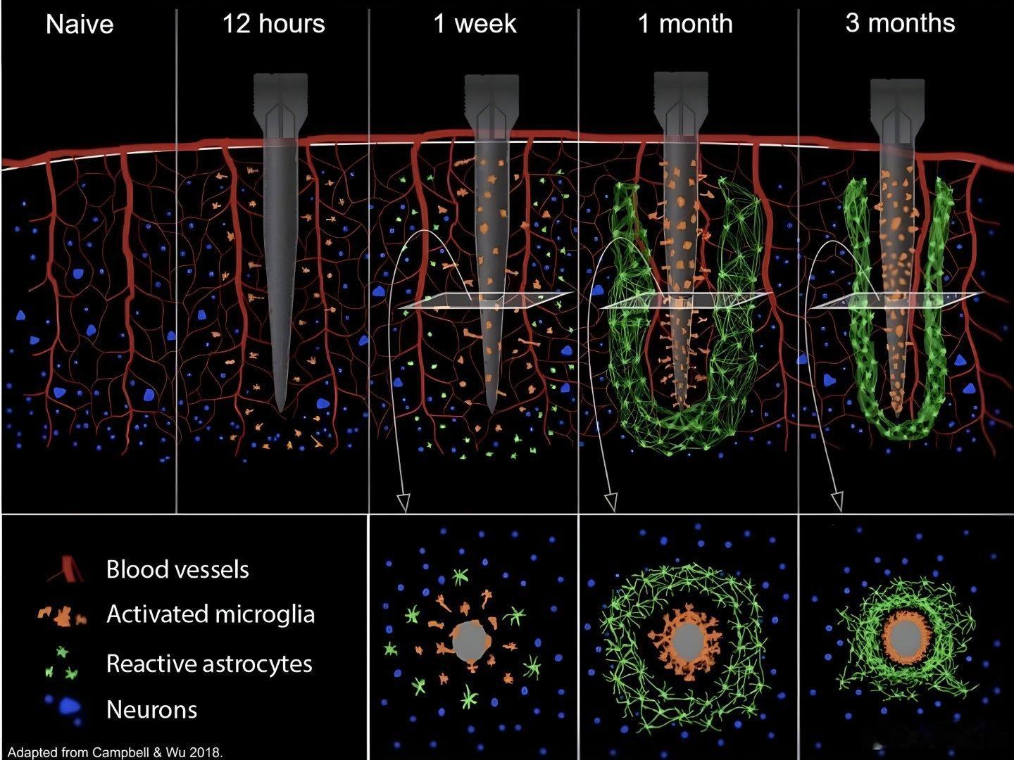 Neuralink 正在对 N1 脑机植入体进行重大升级电极数量仍为 1,024