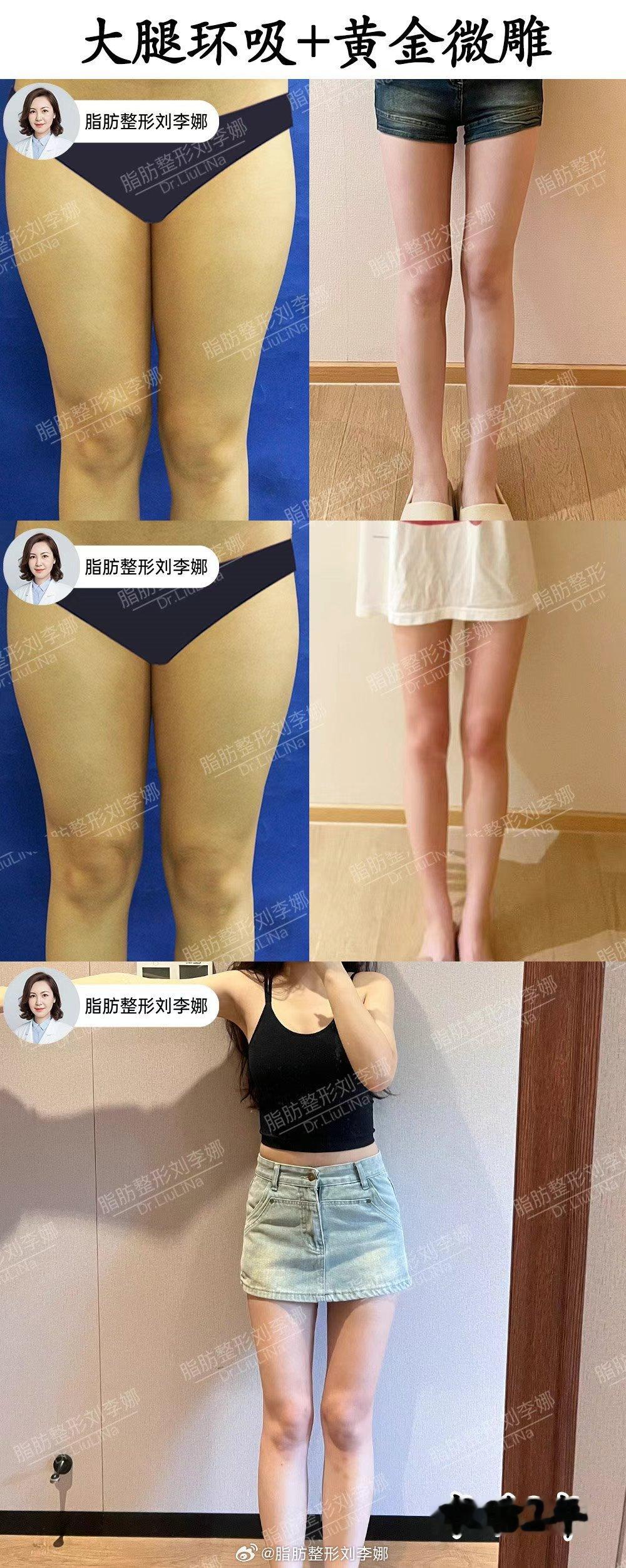 脂肪整形刘李娜大腿抽脂大腿吸脂 大腿环吸+黄金微雕术后2年长期反馈，肉眼可见的假