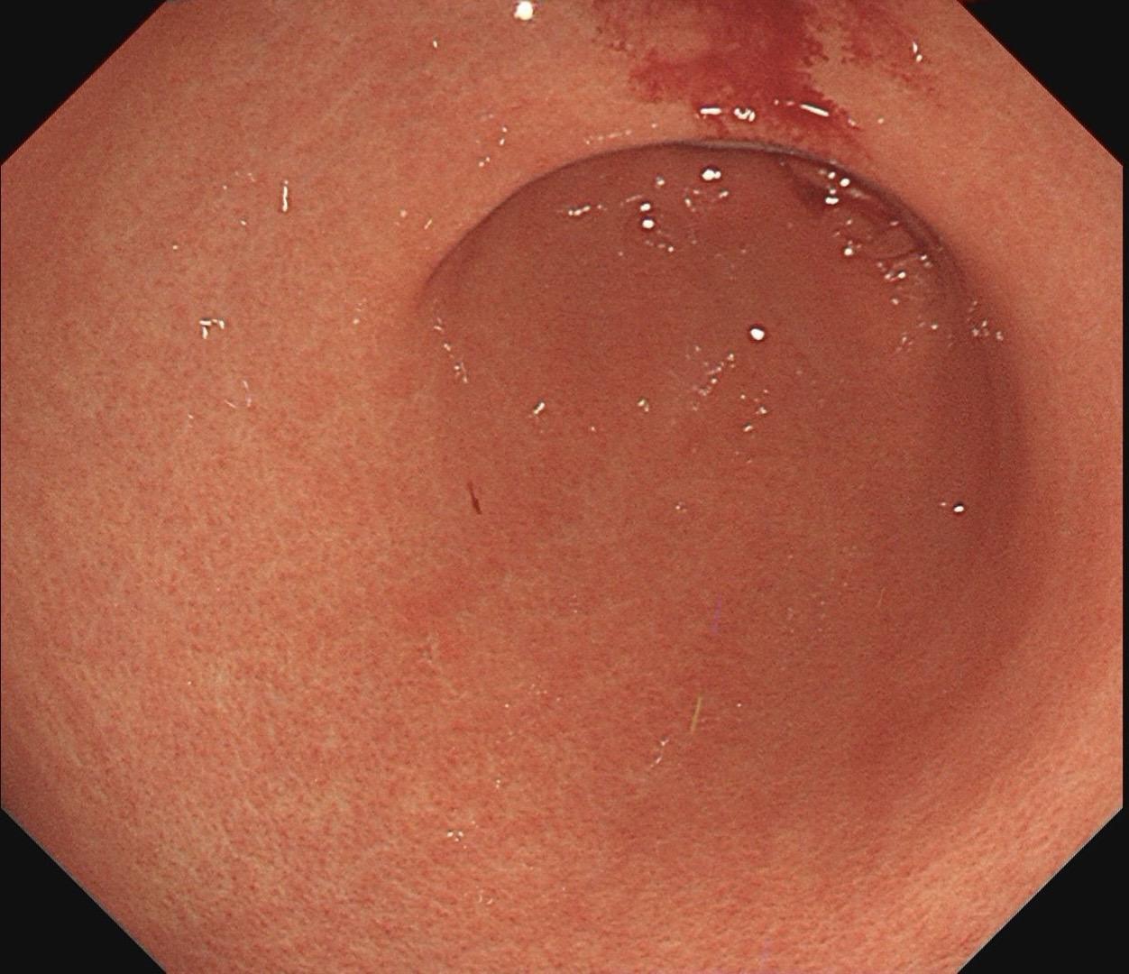 小小的糜烂一枚。这样的病灶，就算结果是阴性的，也很有意义～