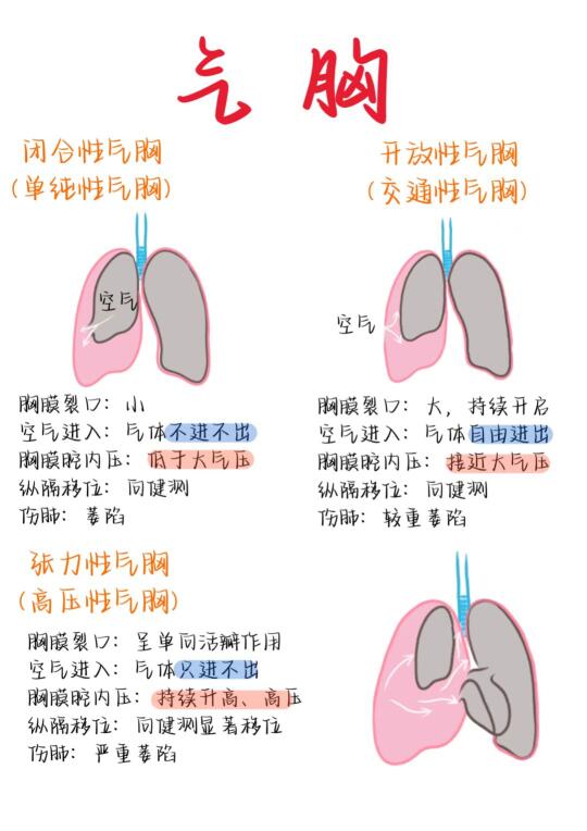 医学生笔记——气胸