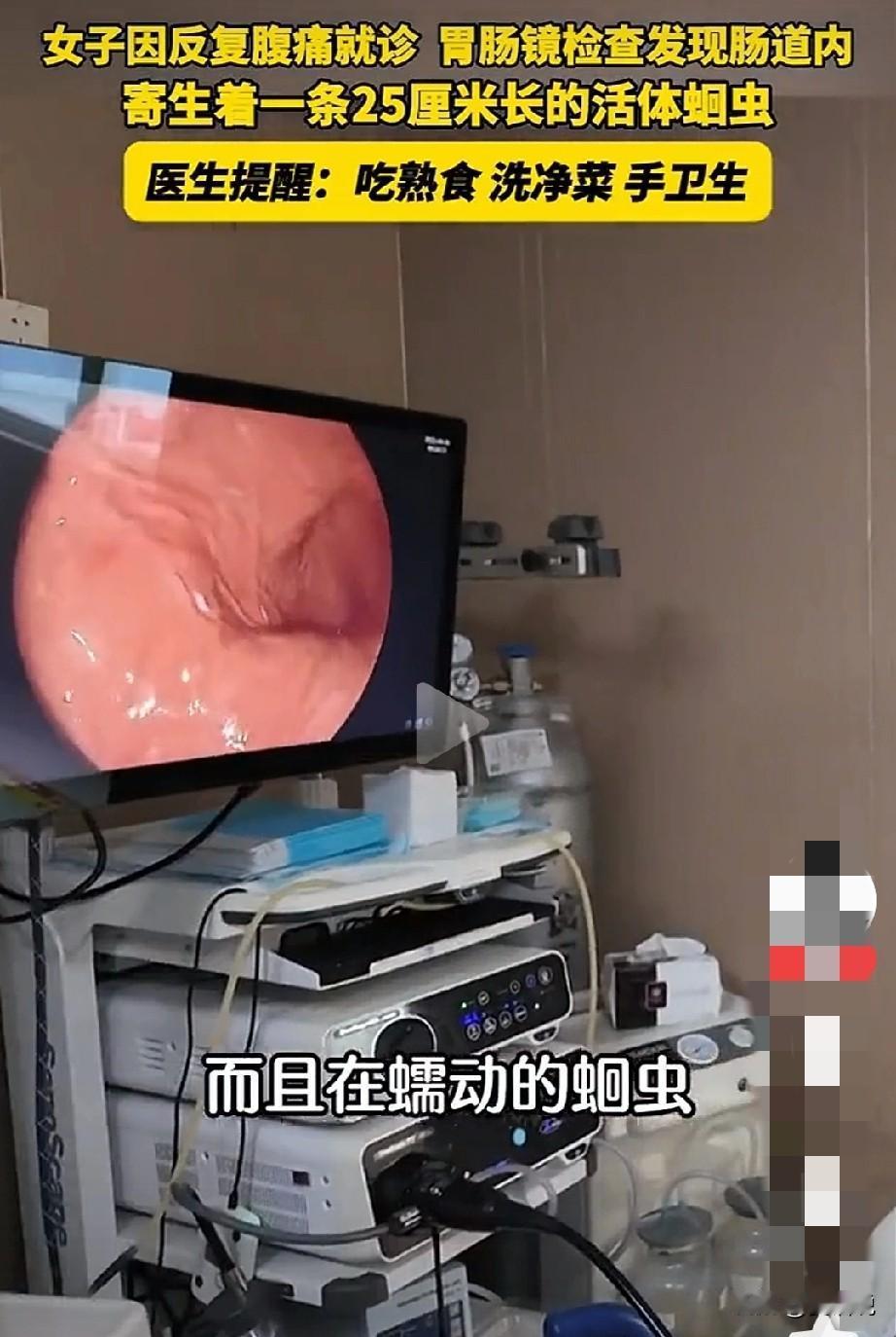 女子仿佛腹痛，经查腹中有25cm长活体蛔虫。小时候，小孩吃宝塔糖，第二天能拉蛔虫
