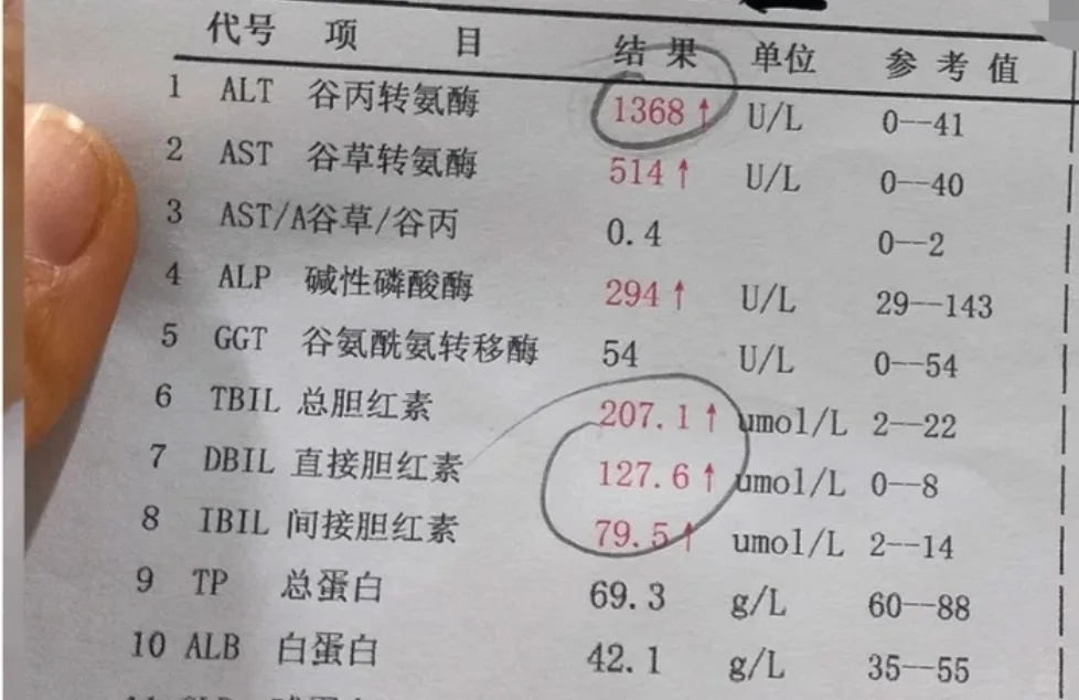 肝功能化验单有四看！！！