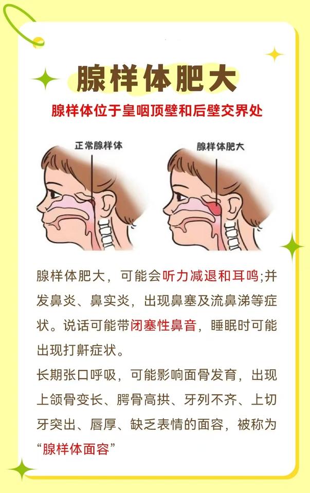 【腺样体肥大的影响】
由于腺样体的位置特殊
异常肿大容易对鼻咽部、颌面部、中耳产