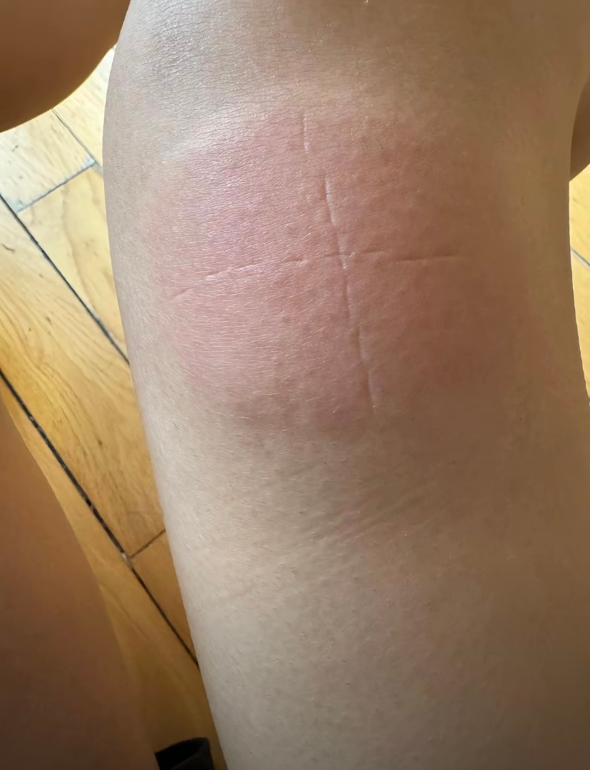 男子被蚊子咬到脖子血管血流不止这个蚊子嘴巴这么厉害啊？！今年的花蚊子确实比以前的