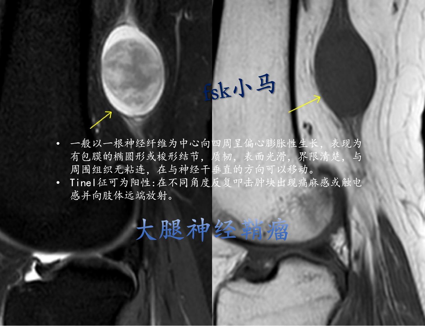 大腿神经鞘瘤