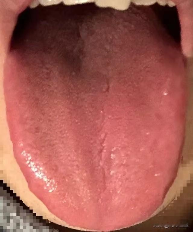 舌头红成这样还正常？赶紧泻火吧，这样要是能补进去才怪了

昨天看诊见到这样一位患