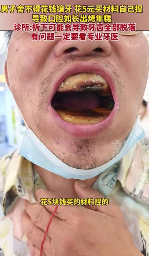 一位男子因舍不得花钱去镶牙，就自行在网上购买了5元材料，自行去镶牙，然而并没有成