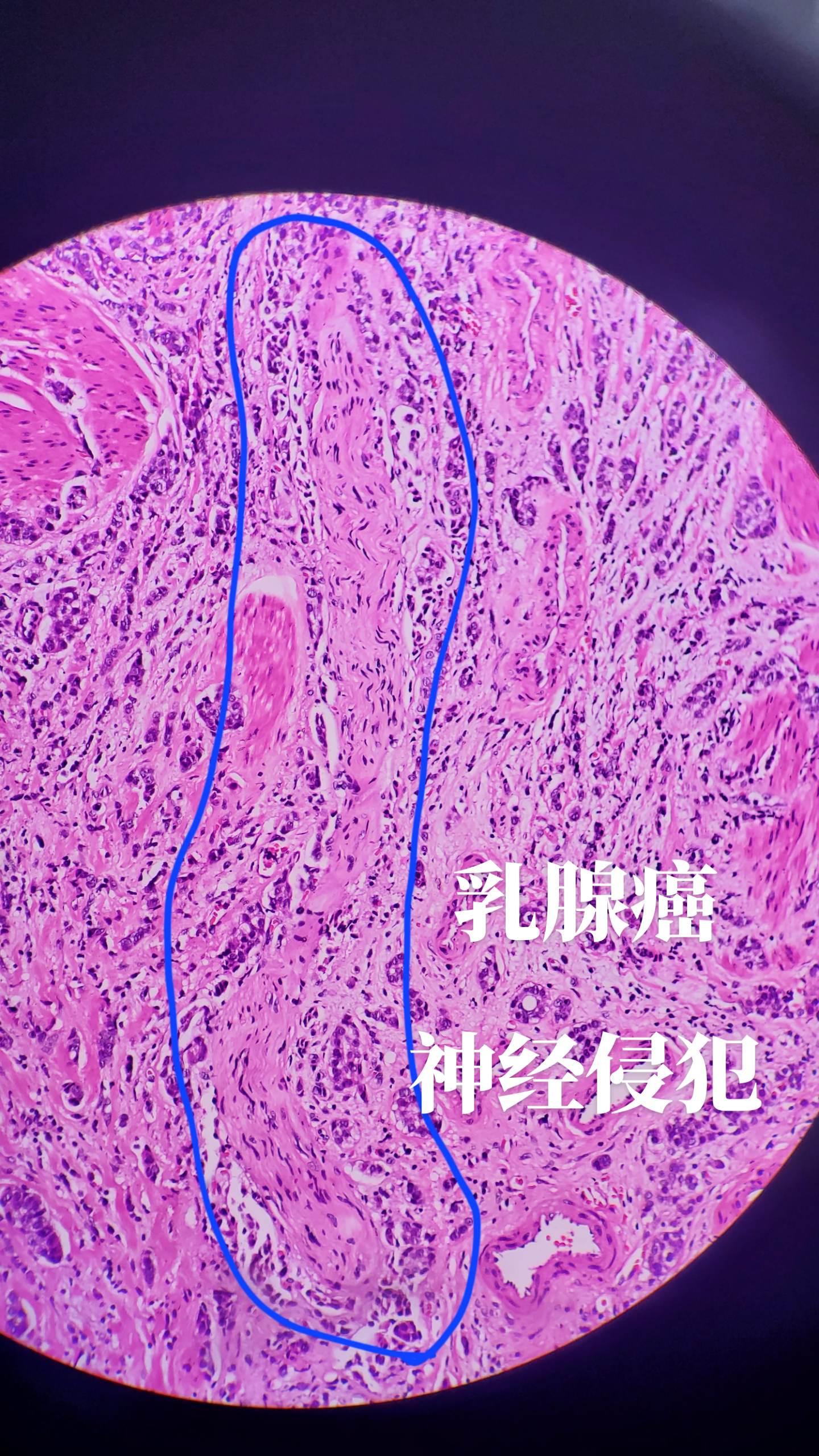 浸润性乳腺癌侵犯神经