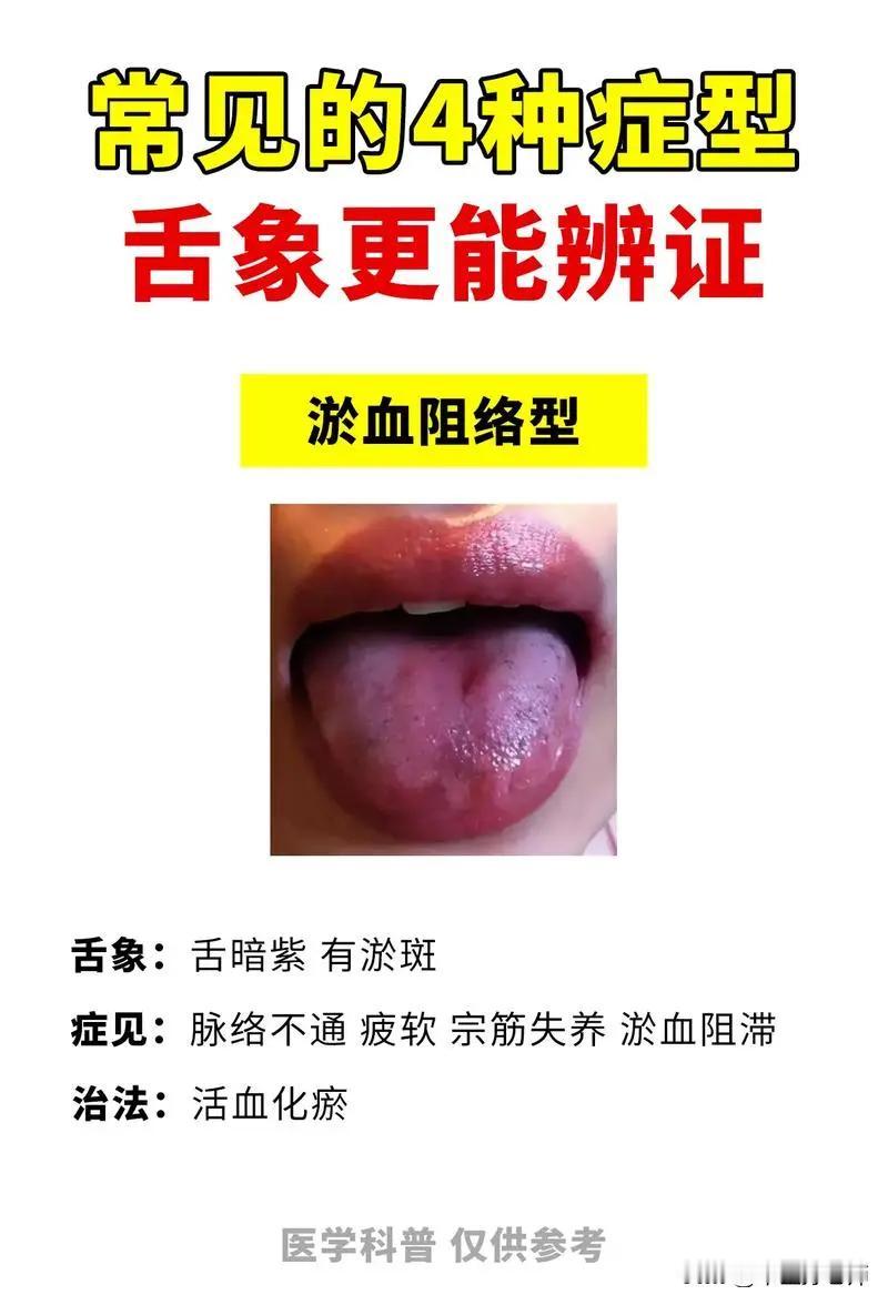 舌象常见的4种症型，看看你中招了没？#健康##舌象#