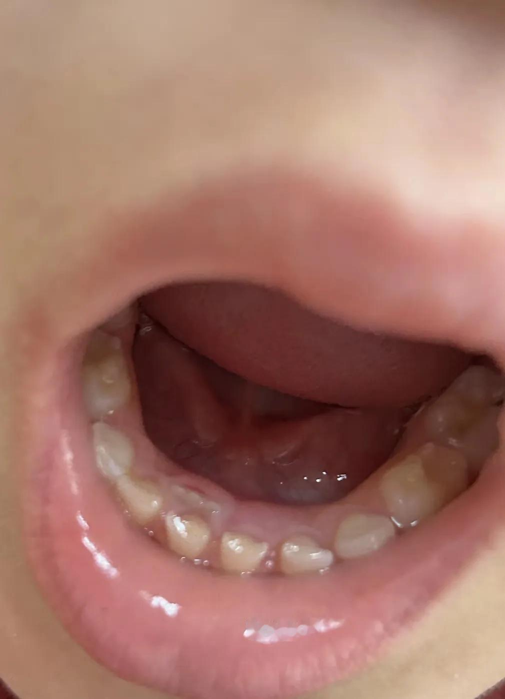 这是啥情况
今天中午大宝说妈妈 我牙里面长牙了
我说啥意思？一看，居然外面的乳牙
