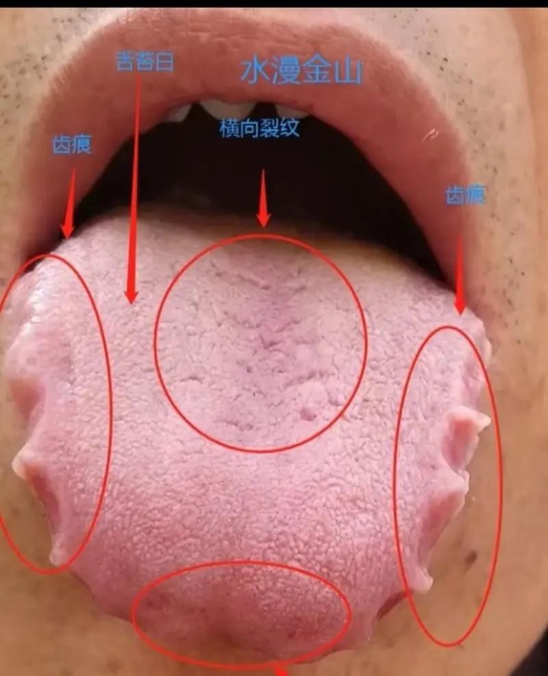 齿痕舌，找找身体有没有水湿的症状。
这个齿痕舌多见是有水湿，当脾虚，脾气不足时，