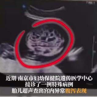 太罕见了！江苏南京，一位女子怀孕后一直都没有什么异常，以为肚子里的宝宝很正常，可