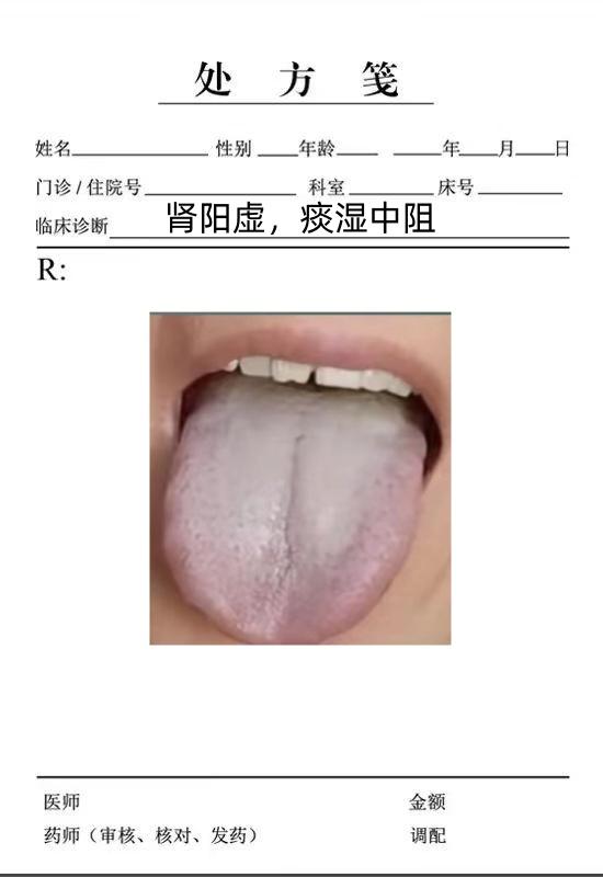 这种舌头有两大淤血瘀、痰淤，病之根本在于升阳行气。
我一看患者的舌像有两点问题比