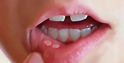 口腔溃疡如何预防？#新手爸妈指南##儿童健康守护者计划# 

平时生活中可以通过