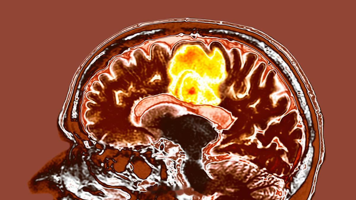 健康知识动态 ScienceAlert 报道介绍了一项初步研究发现，一种简单的补