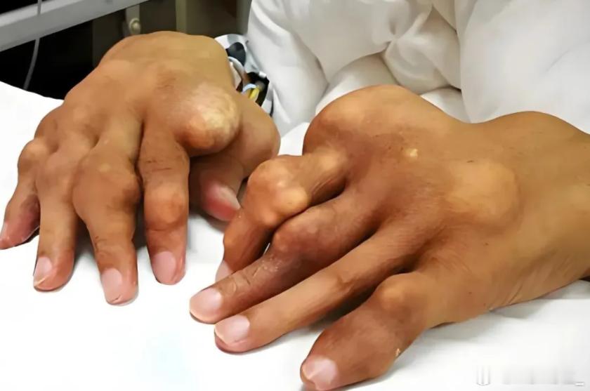 骨头汤不如牛奶补钙 骨头汤喝多了只会嘌呤增高啊，容易高尿酸会长痛风势补钙真不如喝