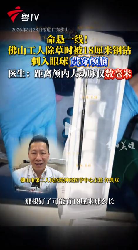 “太险了！” 近日，广东佛山一名男子除草时，被机器弹起的18厘米钢钻刺入右眼，贯