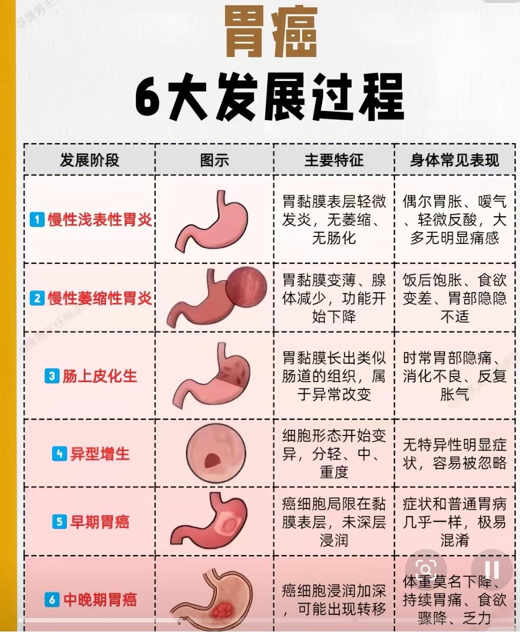 早期胃癌多数情况下能治好，但不是百分百。早期胃癌症状不明显，易被忽视，定期胃镜检