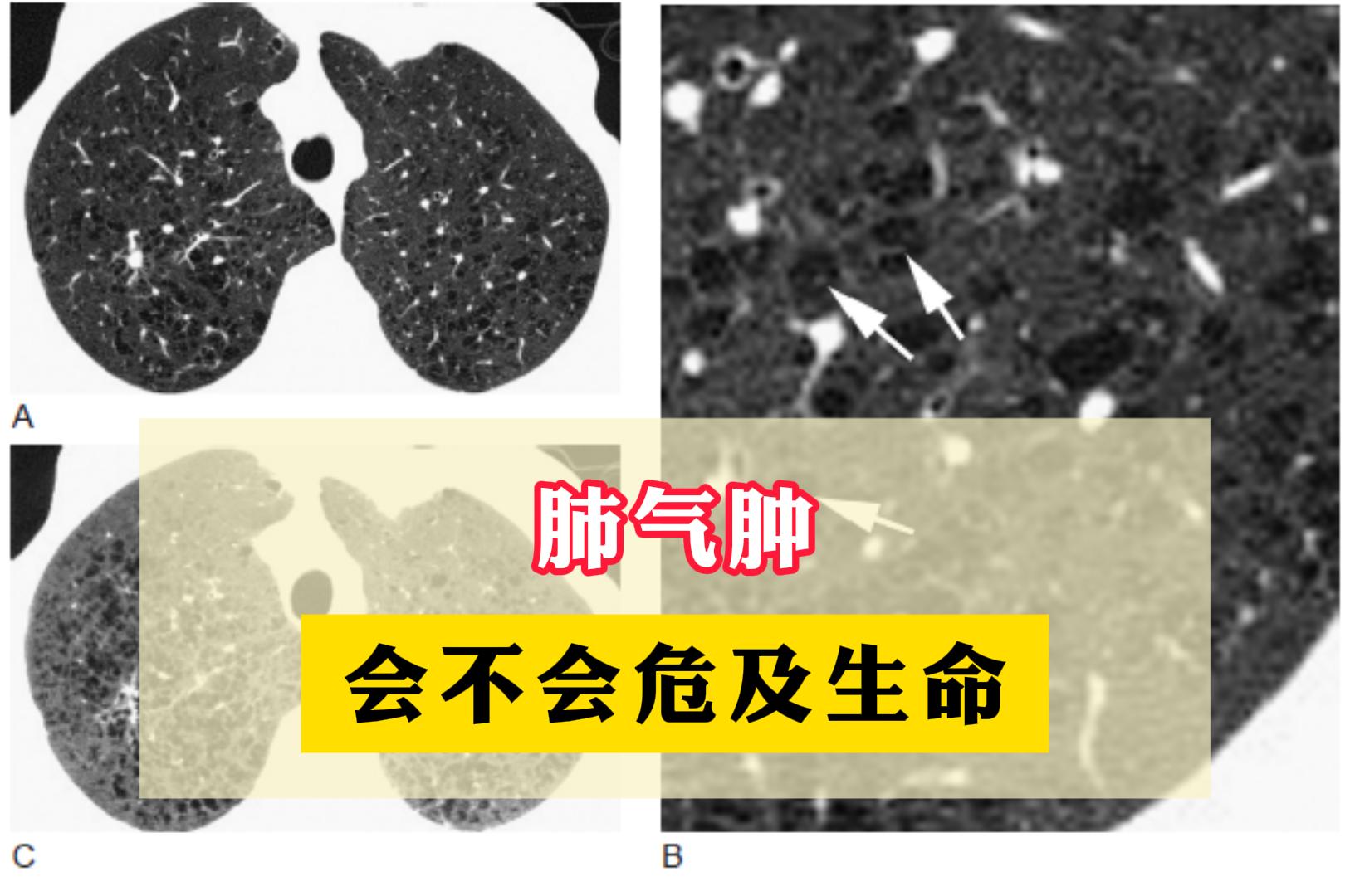 肺气肿 会不会危及生命？。作为呼吸科大夫，常被患者及家属问到：“肺气肿...