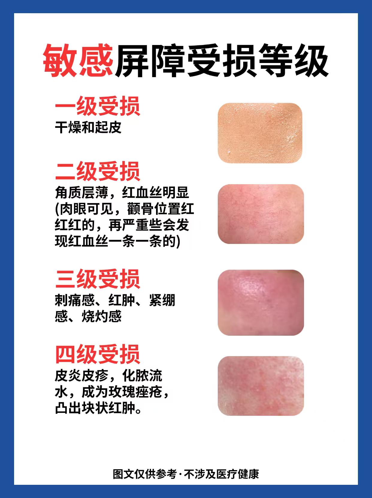 敏感肌屏障受损等级