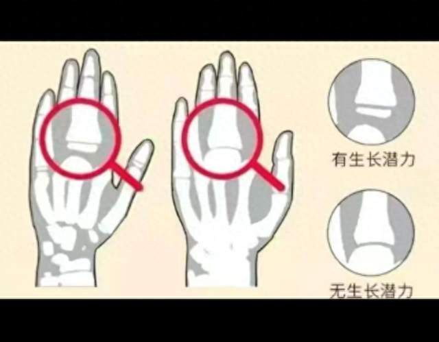 控制骨龄最简单的方法！做好3停4忌，助力孩子理想身高