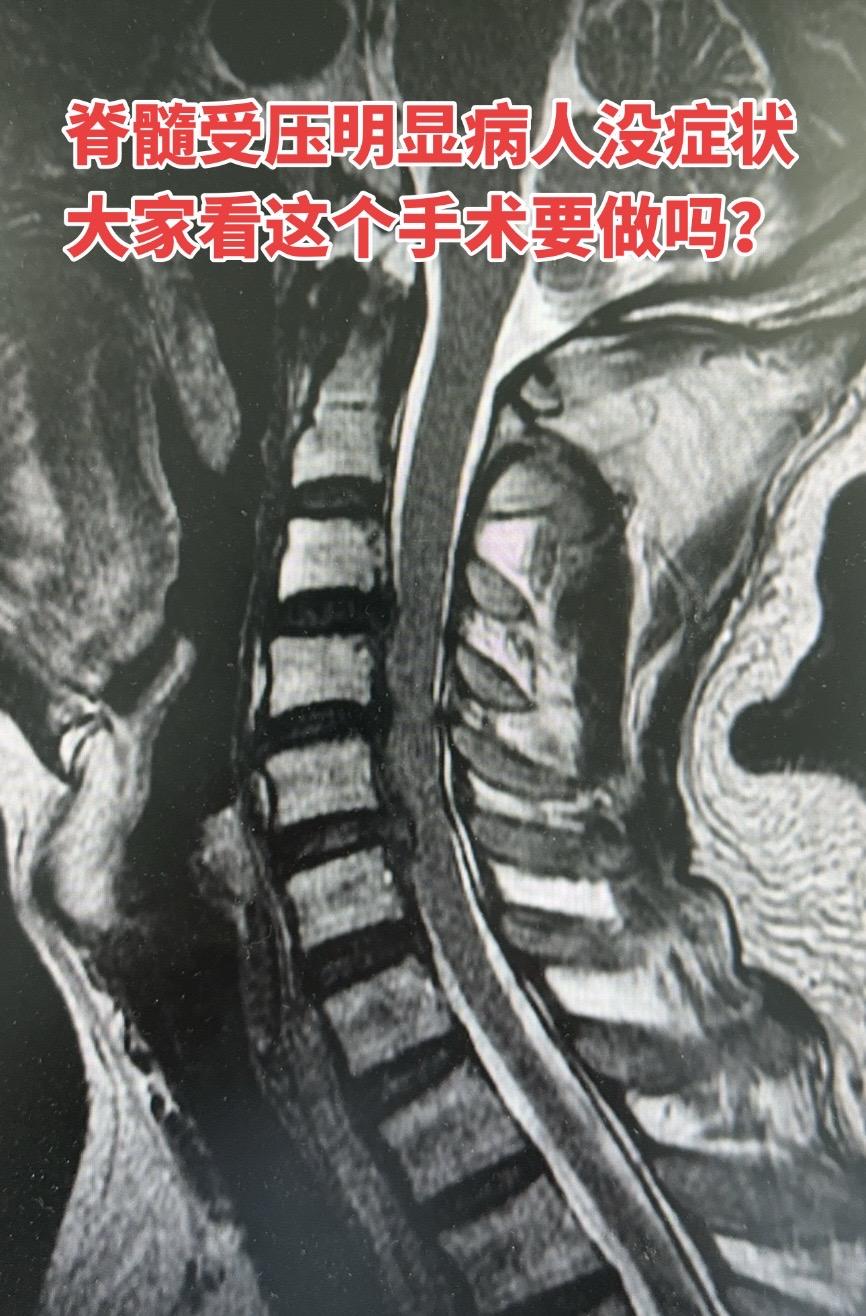 一个颈椎脊髓受压很明显的病人，病人说没有任何症状，大家觉得这个手术要做吗？