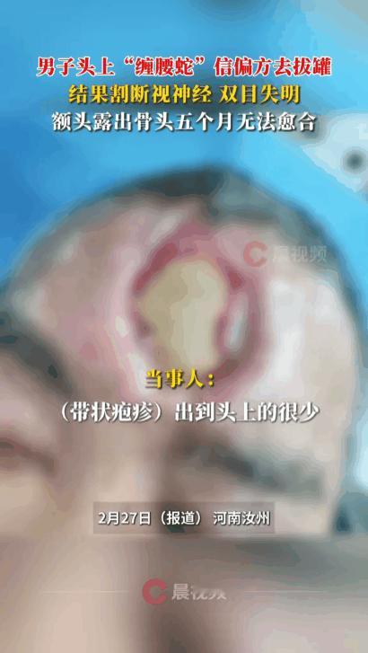 “病急乱投医” 能有多可怕？近日，河南汝州，一名男子头上长了 “缠腰蛇”（带状疱