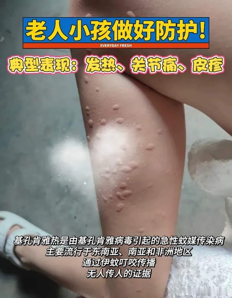 全球已近30万人感染基孔肯雅热佛山市5个区已累计报告基孔肯雅热确诊病例超过400
