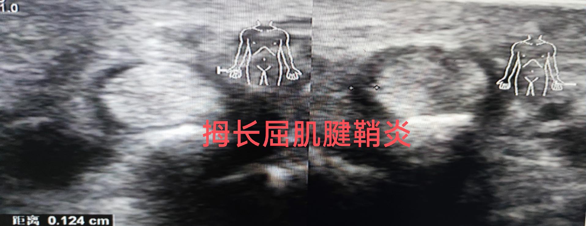 拇长屈肌腱鞘炎 。妈妈手”、“手机手”等，都是腱鞘炎。 女，54岁，拇...