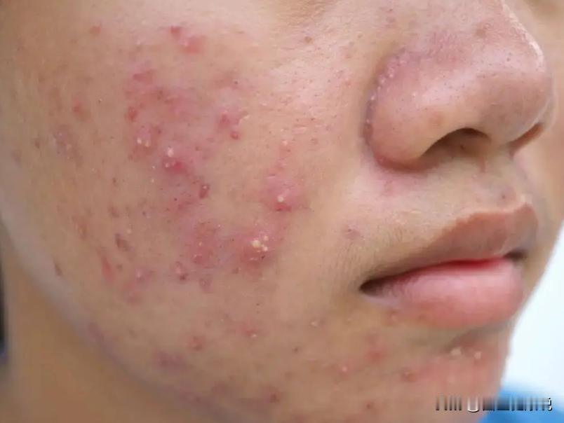 脸上长痘怎么调？
 
脸上总是长痘痘真的很让人困扰，这边的痘痘还没好，那边的痘痘