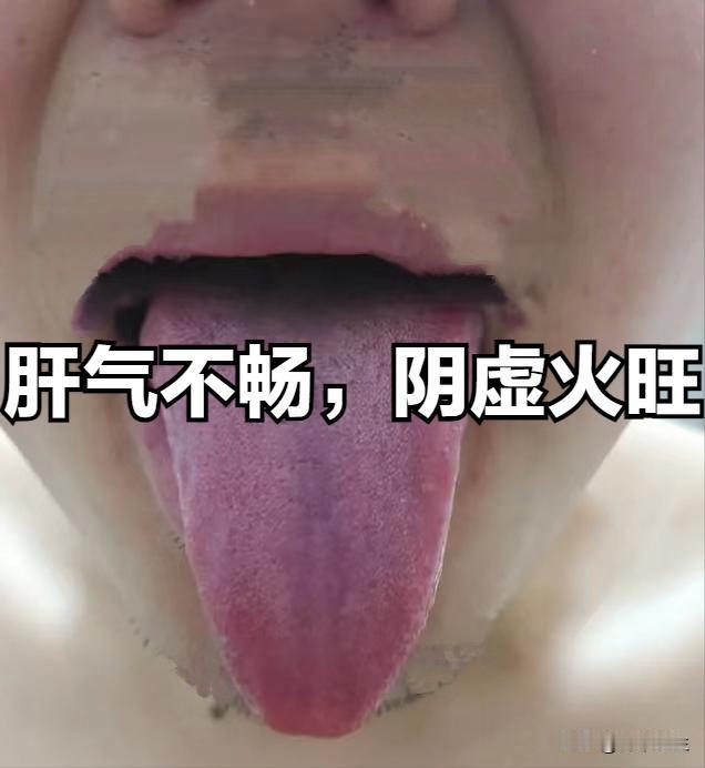 今日舌象总结

（一）脾肾阳虚，下焦痰湿
症状：舌体胖大，舌质淡白，舌边有齿痕，
