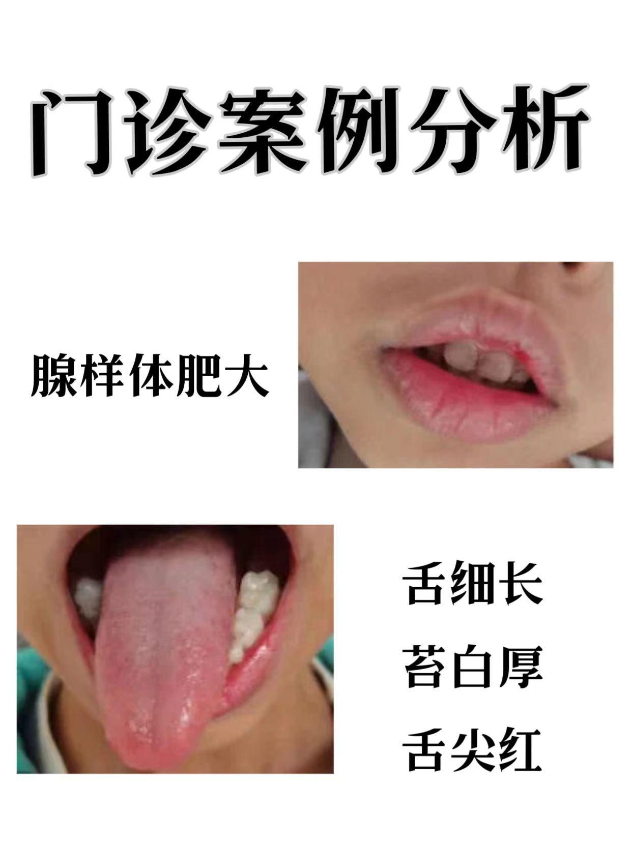 腺样体肥大，说到底还是脾胃不好，火从上面走了
 
前段时间我看诊了一个6岁男孩，