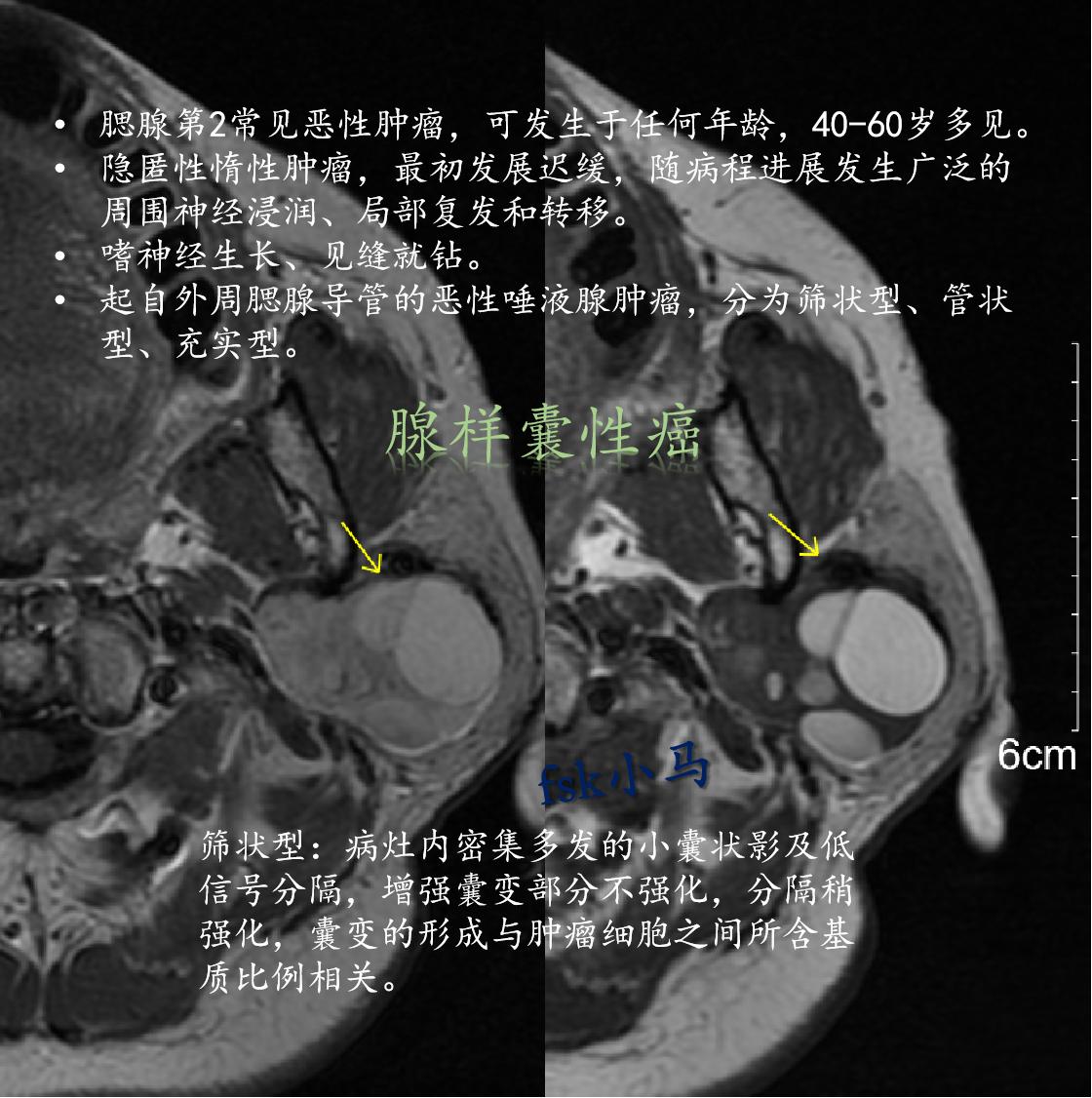 腮腺第2常见恶性肿瘤，可发生于任何年龄，40-60岁居多，无明显性别差...