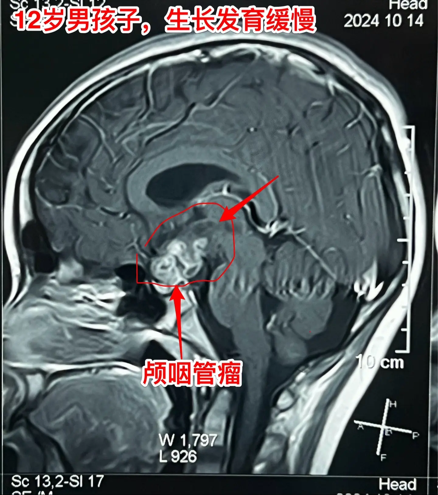 孩子生长发育缓慢，家长要重视。这个12岁的男孩子，在深圳生活，平时爱运...