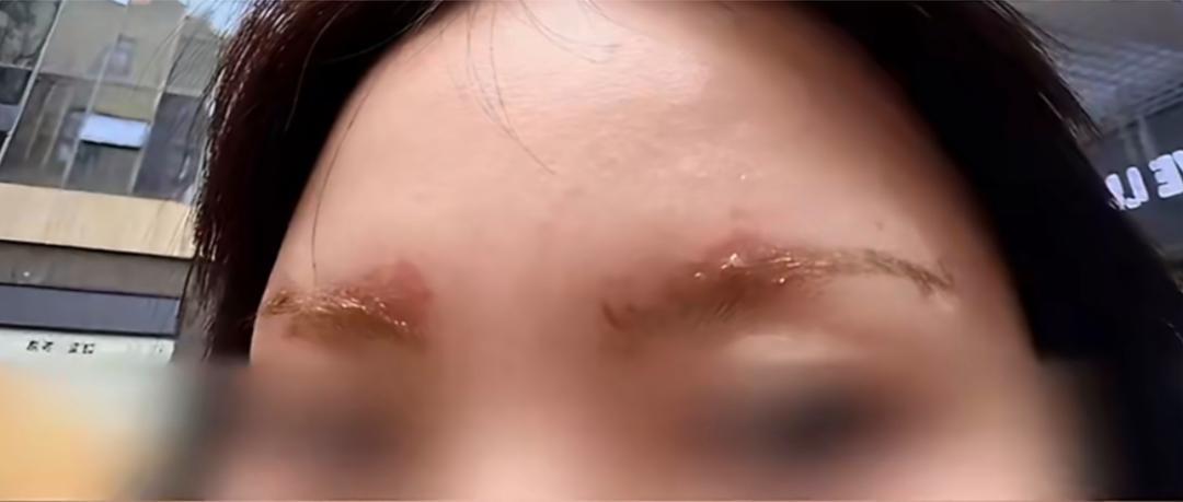女子在理发店染发顺便染眉，皮肤被化学腐蚀灼伤遭拒赔，门店回应：不会跑路，还在协商