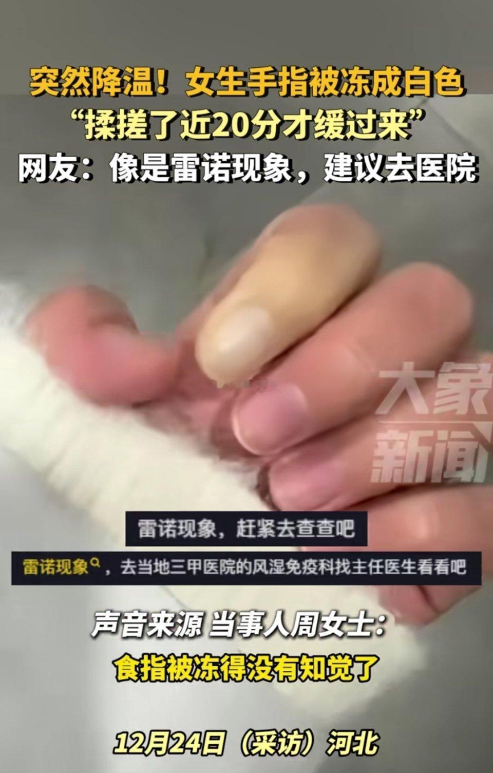 突然降温！女生手指被冻成白色